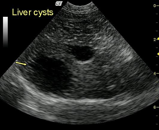 SANDYWINFILEDBENIGNHEPCYST_1an_04302009021823