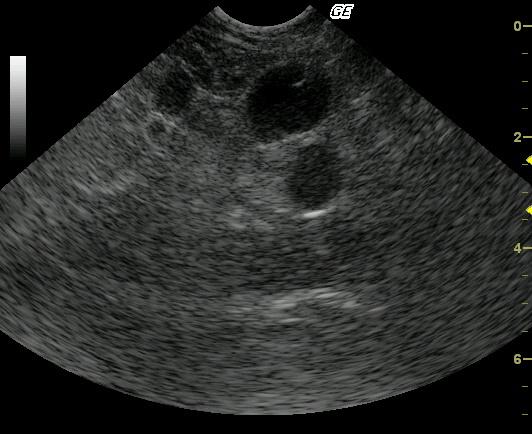 tbone_fna_node_01202010090441