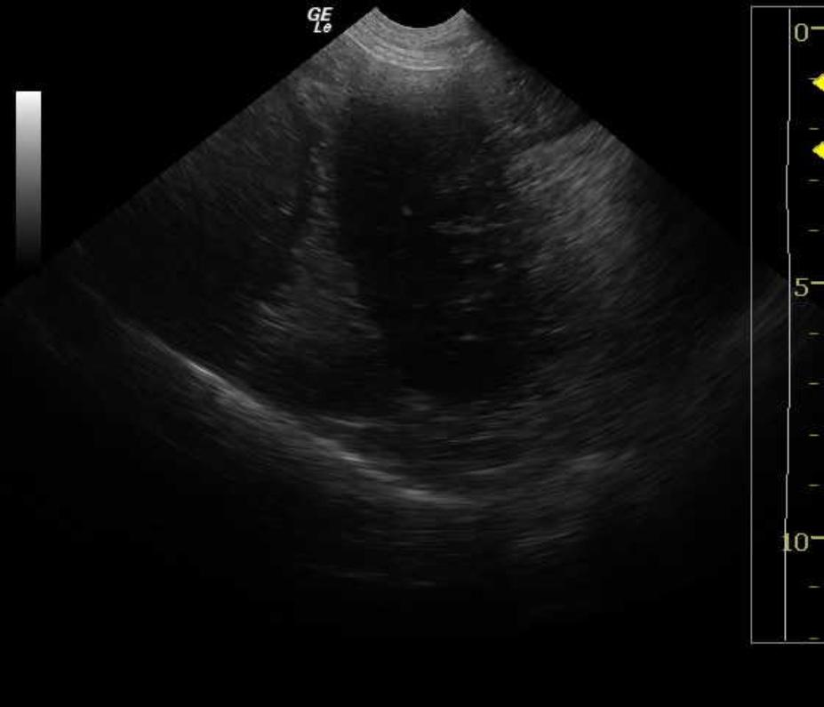 PadoverIntestDilatation