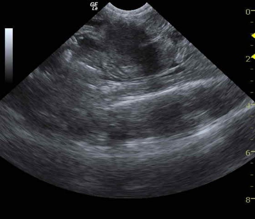 MesentericrootLymphadenopathy