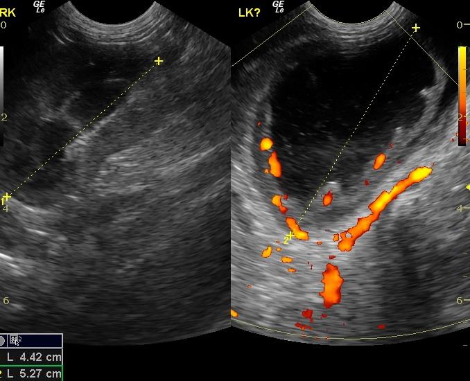 PerinephriccystwithPowerDop_03042011060056