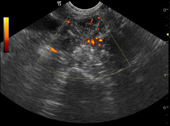 PowerDopplerprostate