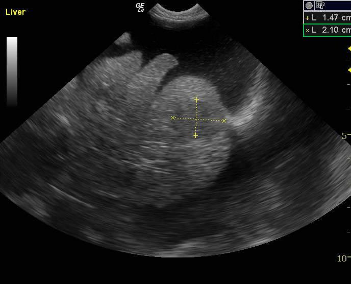 MetastaticNodule_07162011103607