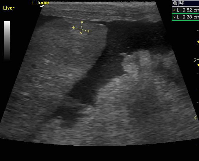 MetatstaticCarcinoma_07162011103636