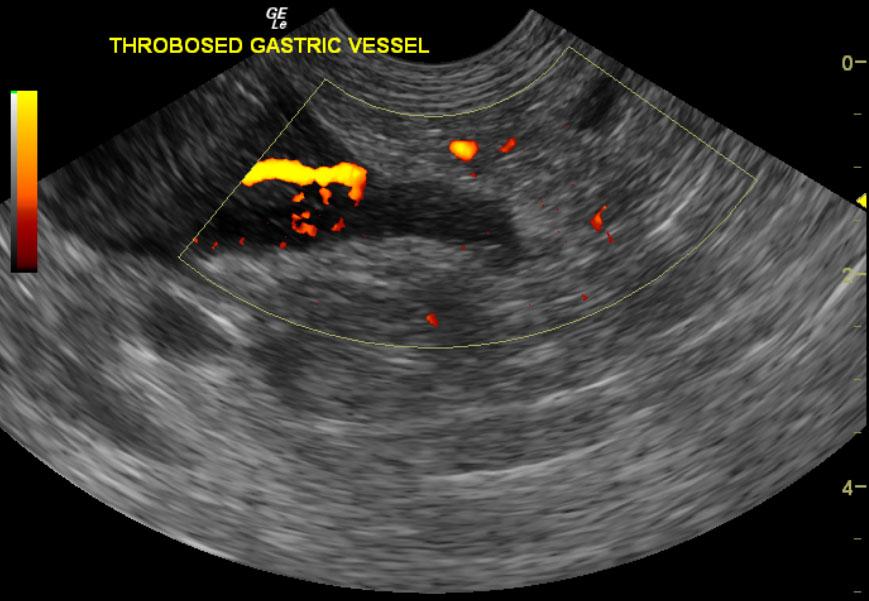 Thrombosedgastricvesselpowerdoppler_07012012022412