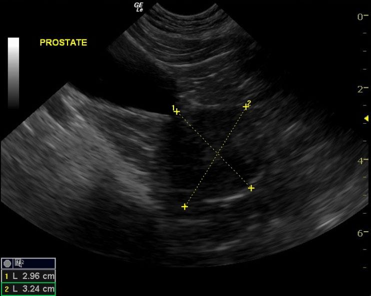 Prostatemeas_11232012040715