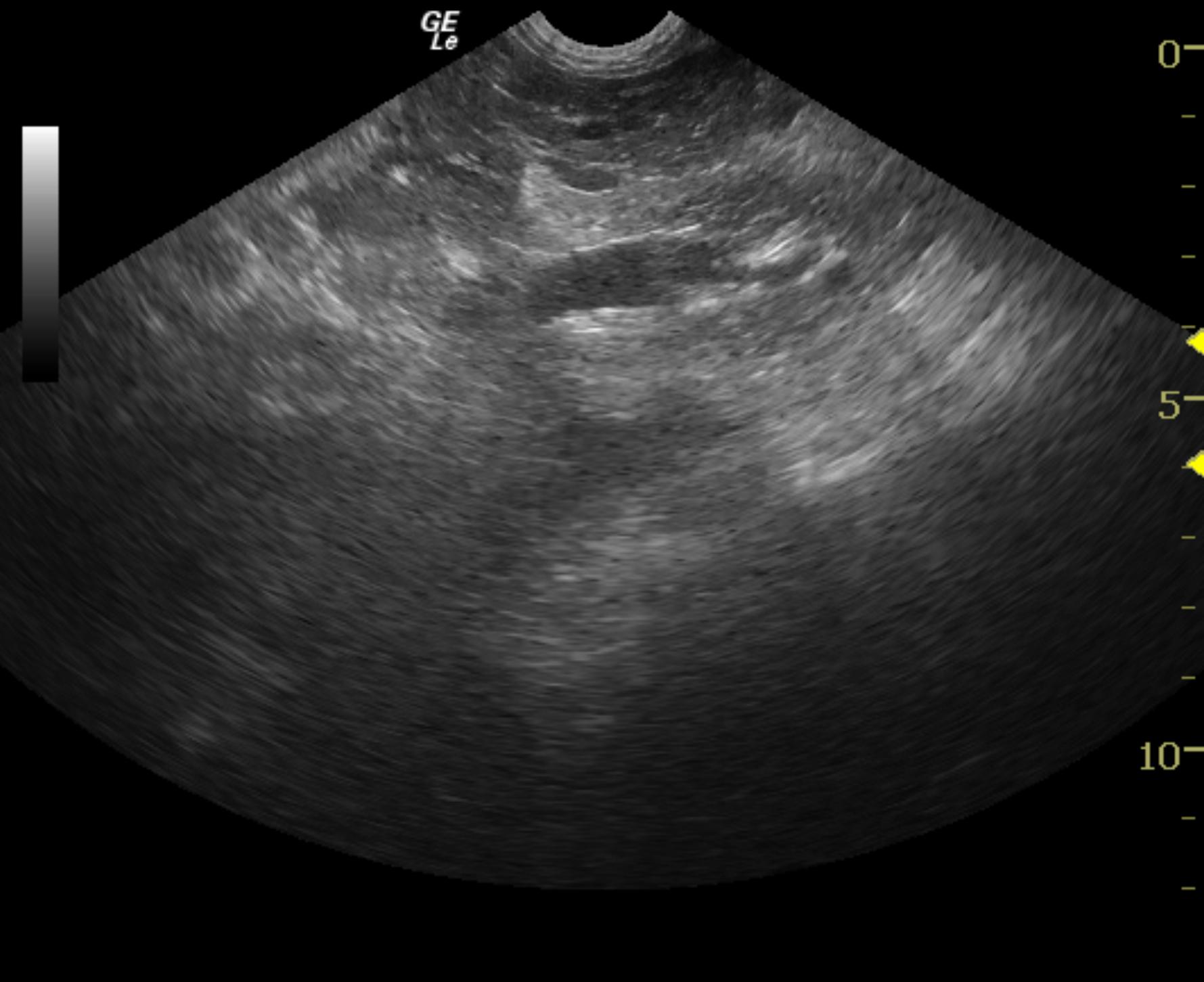 noel_longo_original_right_adrenal_pheo_2_5_08_cvc_clean