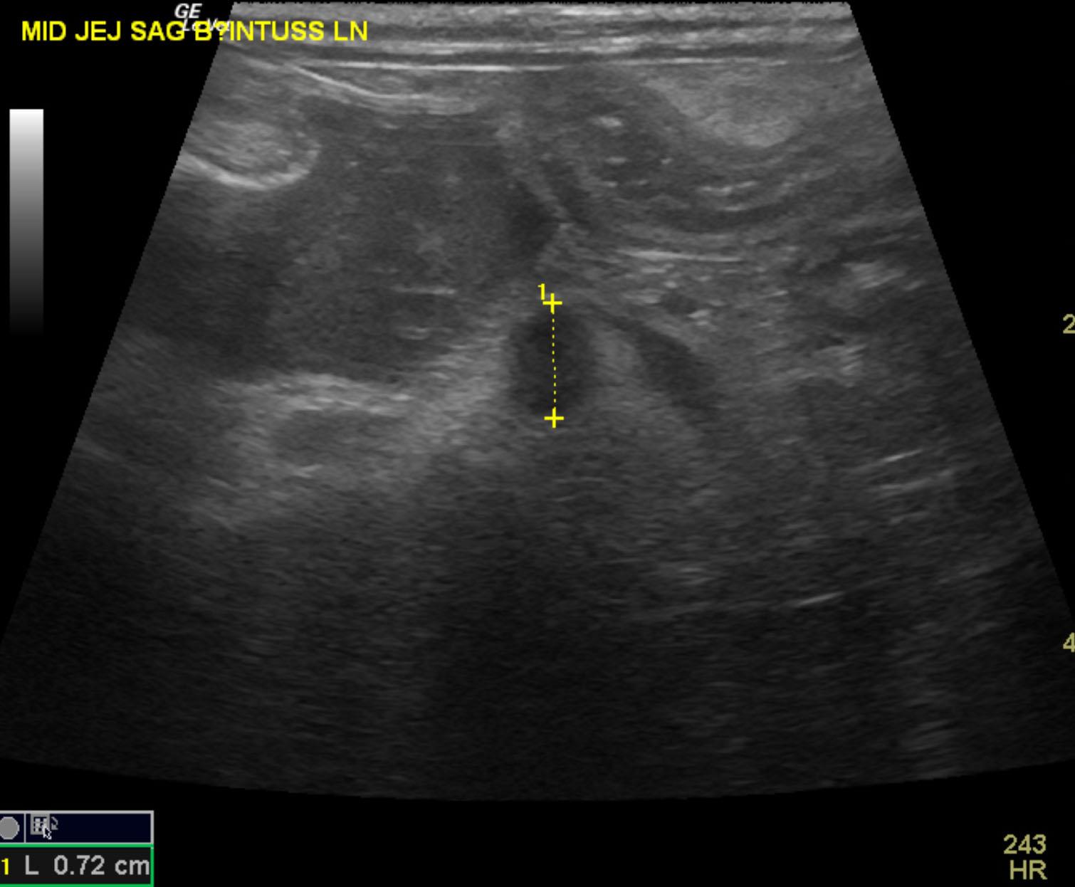 hannah_original_typhlitis_ln_intuss_fake