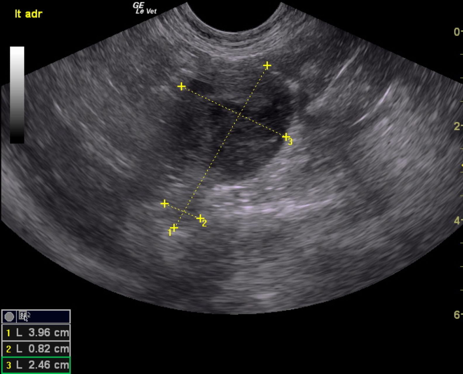 george_hildebrand_left_adrenal_mass_pheo_suspect