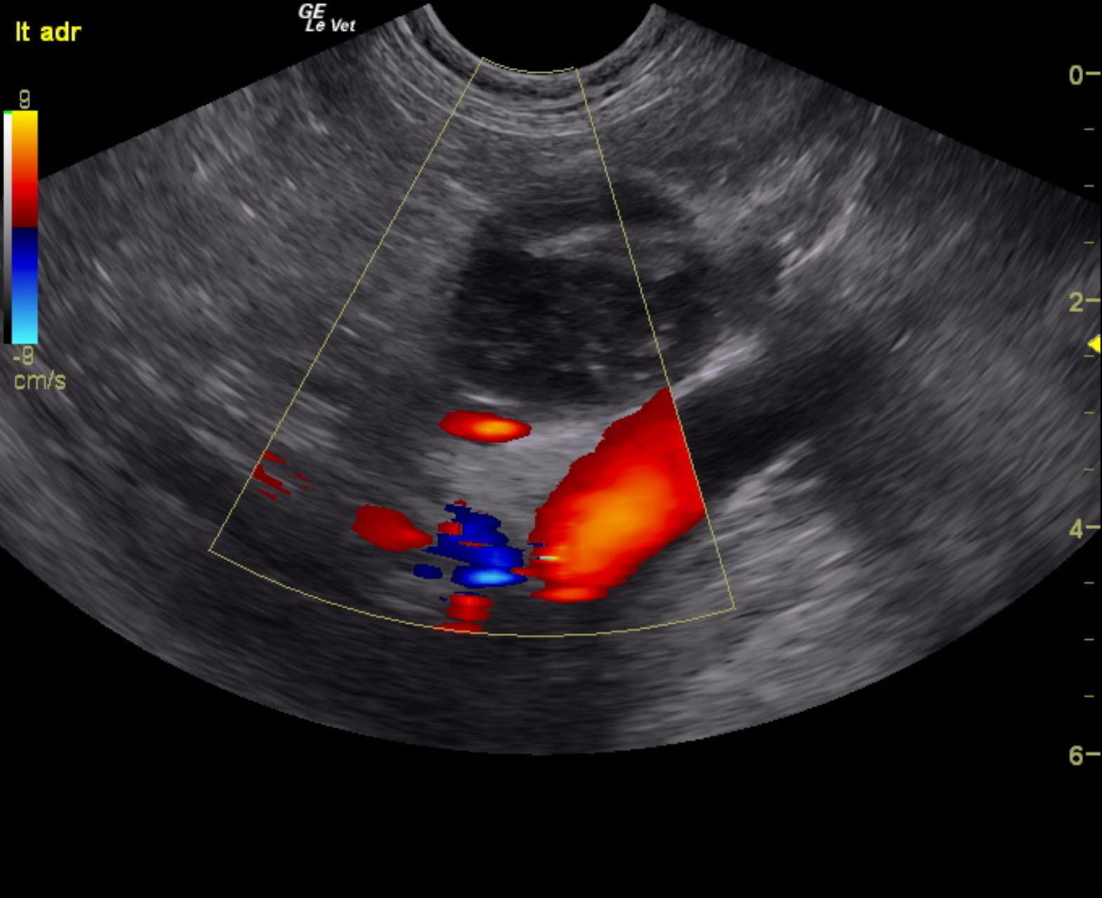george_hildebrand_left_adrenal_mass_pheo_suspect_color
