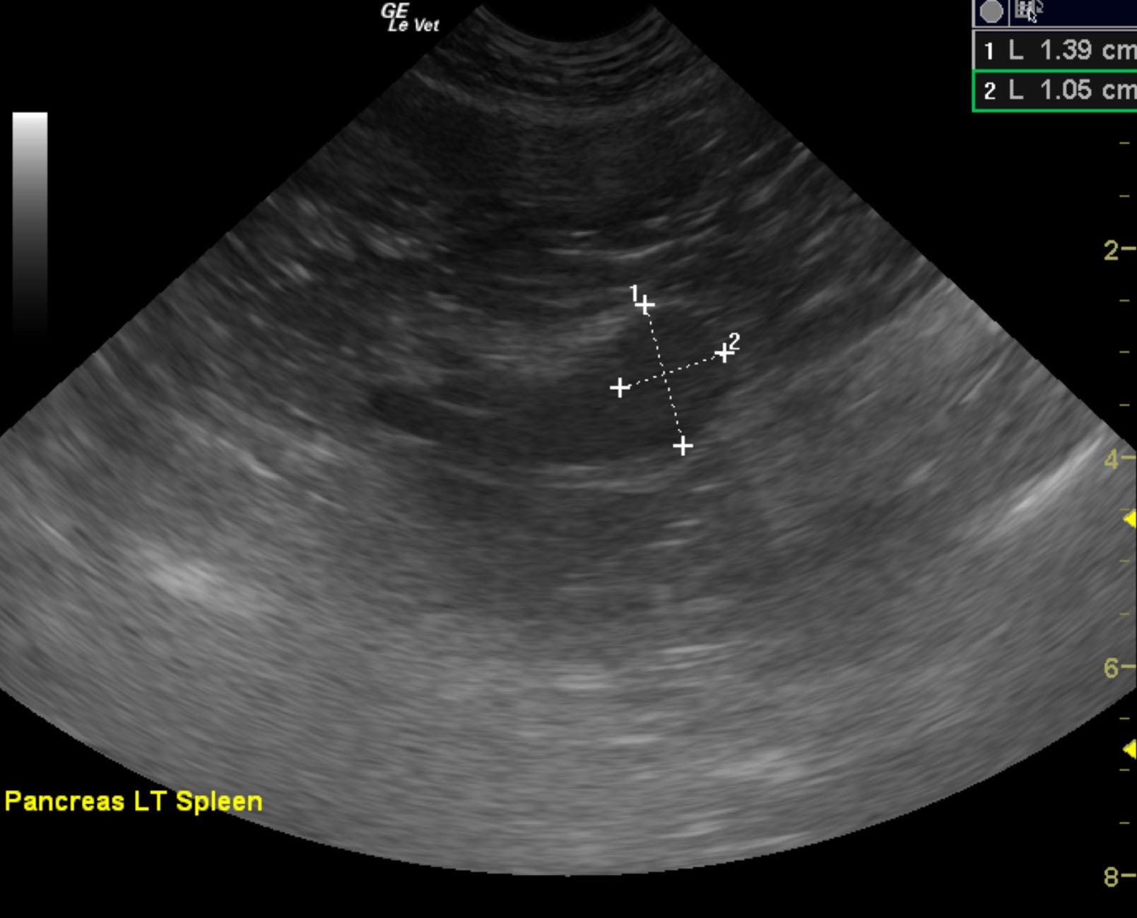 kian_shenal_suspect_insulinoma_fna_panc_or_ln_2