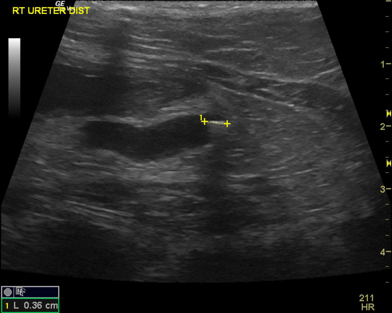 beaumont_tiger_lilly_right_ureteral_obstruction_pancreatitis_rt_ureteral_stone