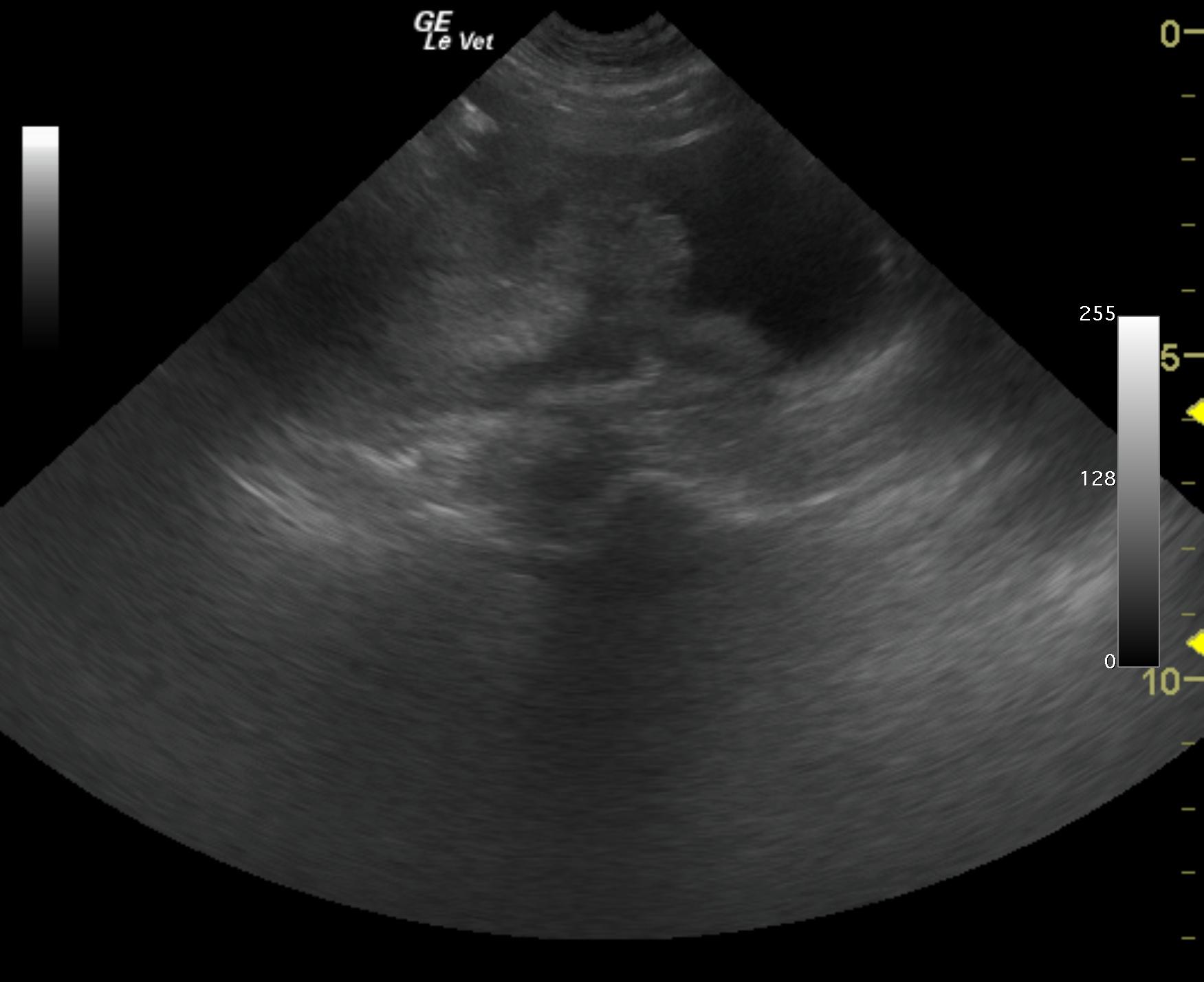 orka_clifton_iliac_ln_anal_gland_adenoca_met_2