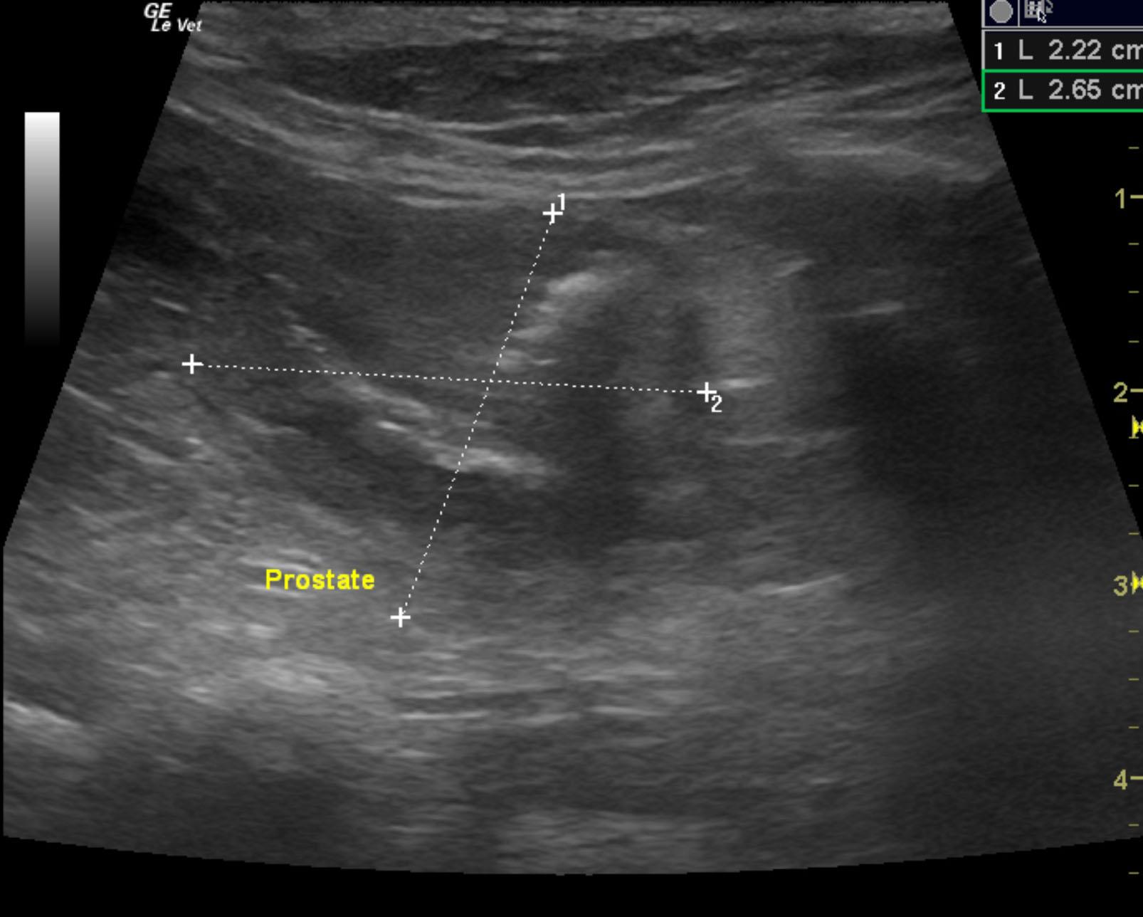 sparky_snider_prostatic_carcinoma_fna