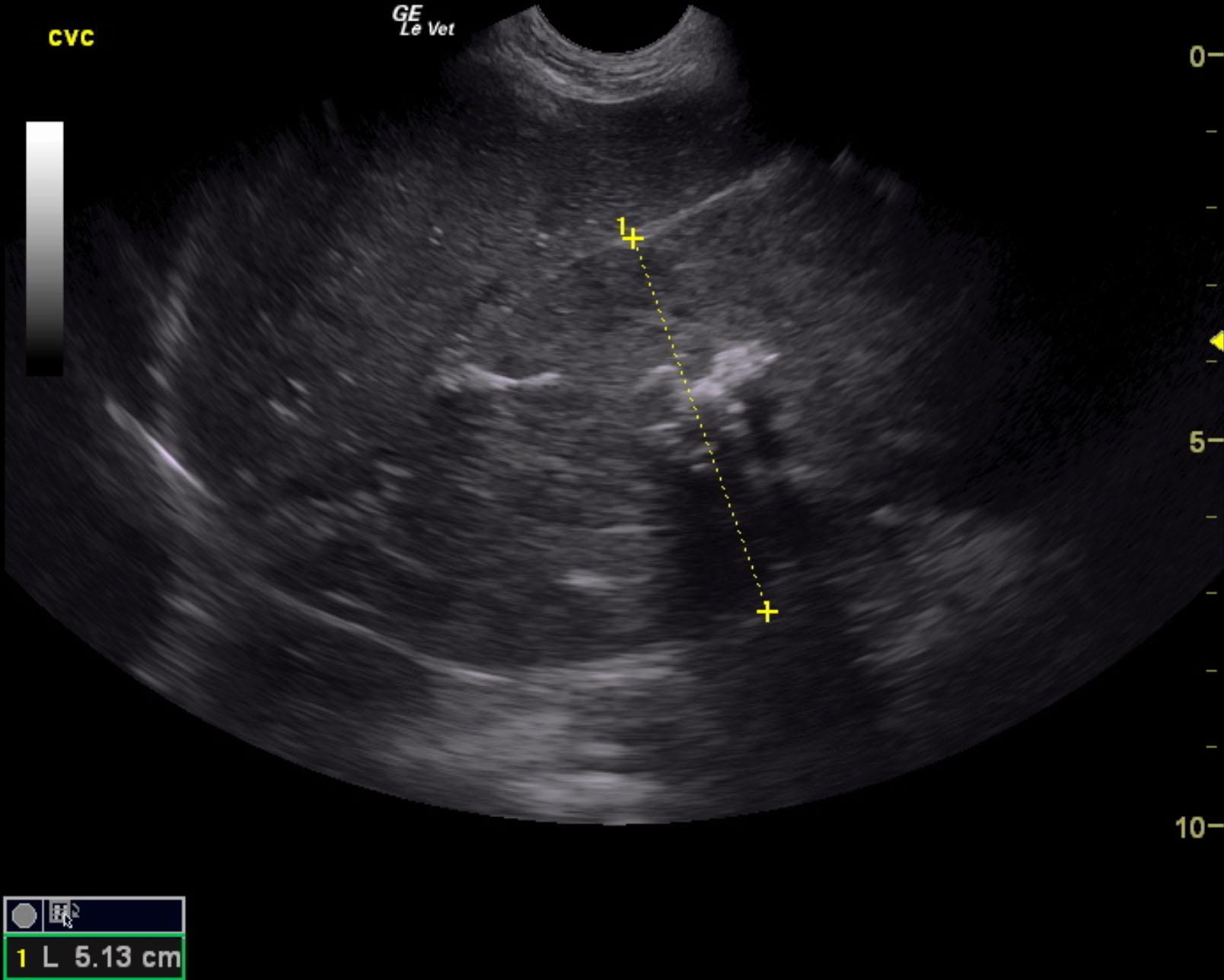 margo_teter_left_adrenal_mass_huge_invasion_cvc