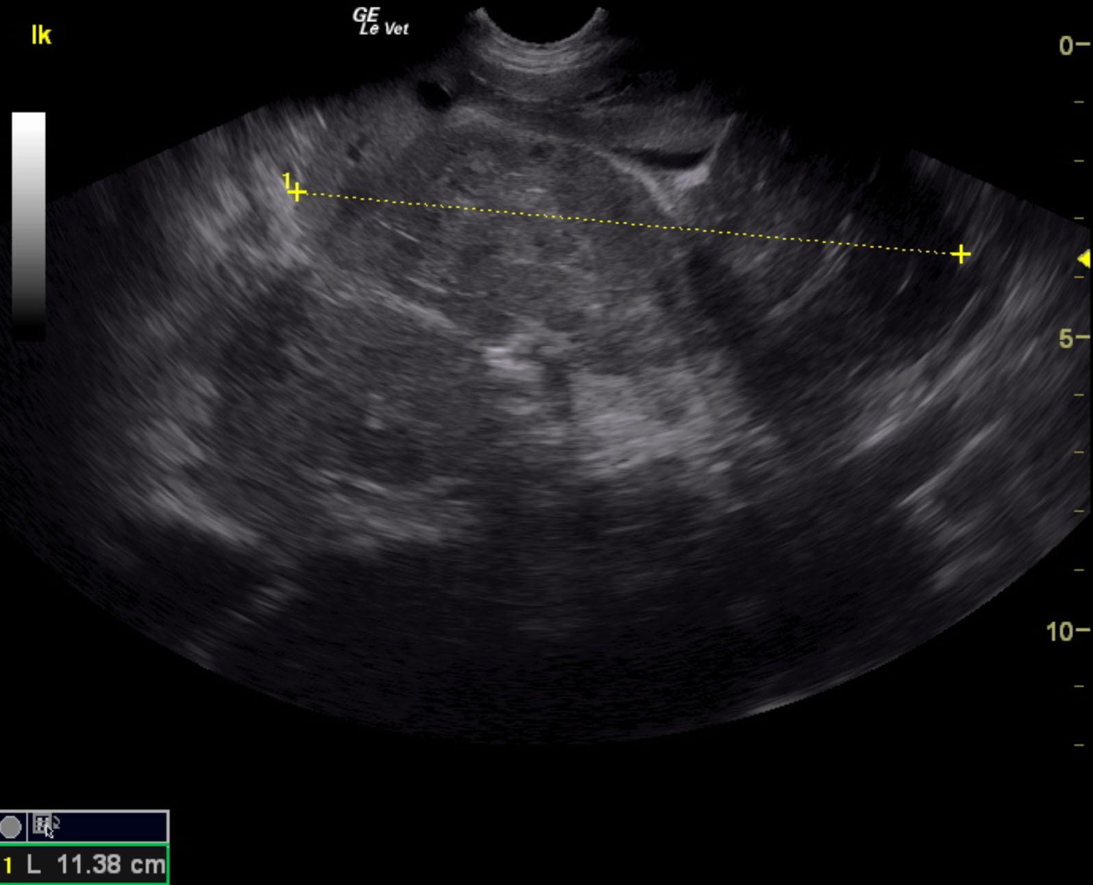 margo_teter_left_adrenal_mass_huge_invasion