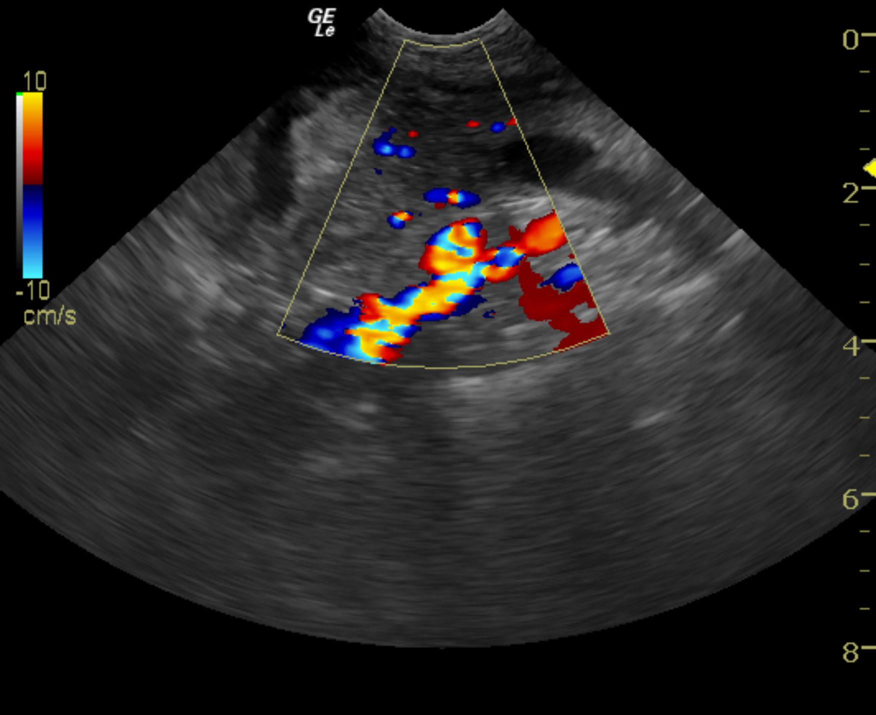 aspen_czoch_bladder_tcc_ureter_obstruction_color