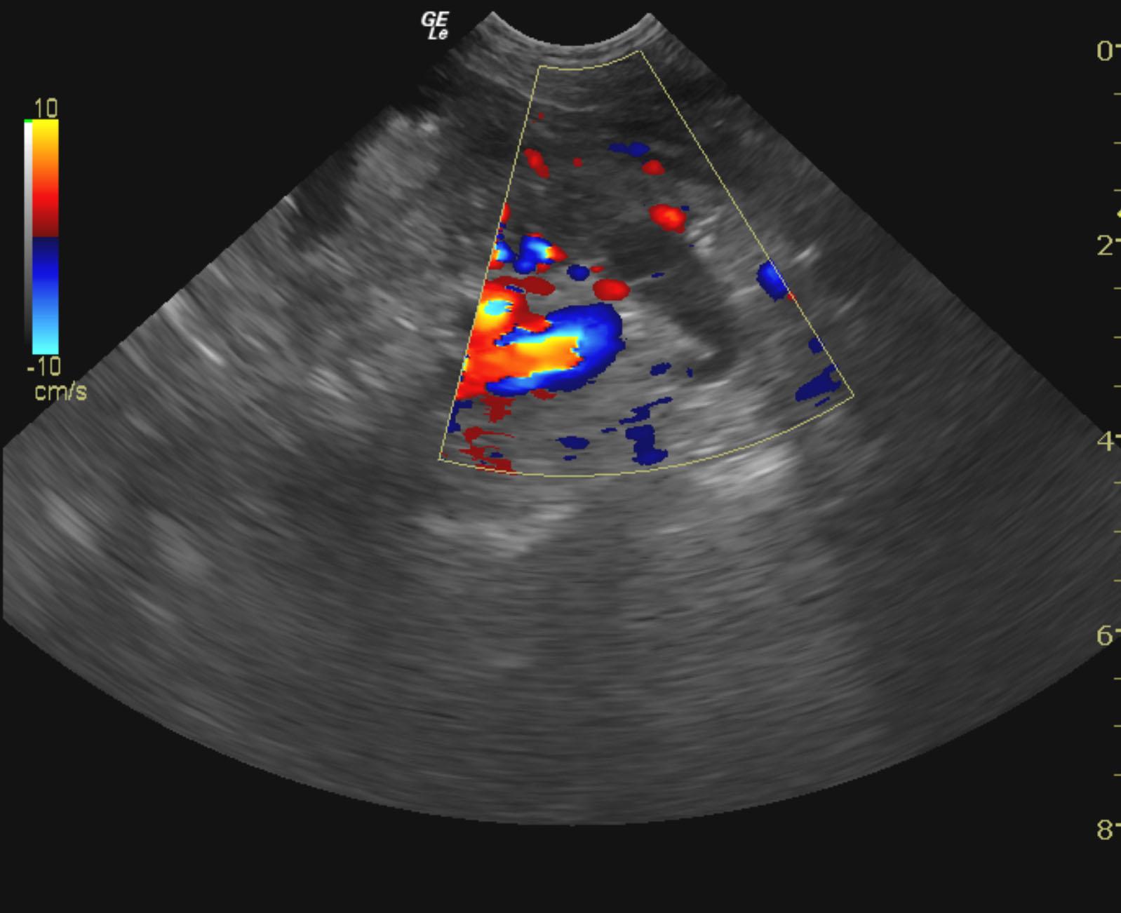 aspen_czoch_bladder_tcc_ureter_obstruction_2