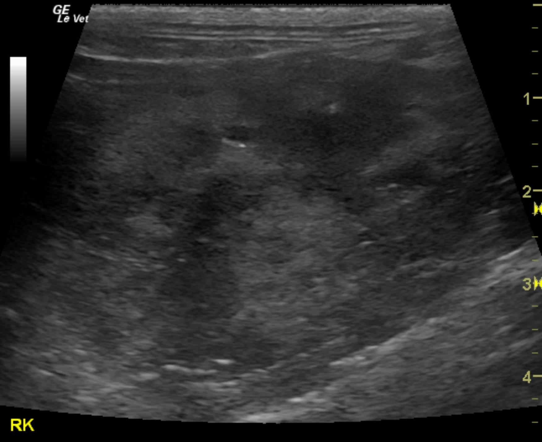 greenfield_luv_leigh_kidney_mass_erythropoietin_tumor_possible_2_