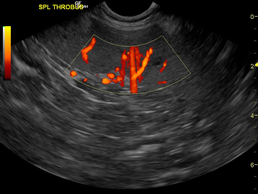 spl_thrombus_doppler