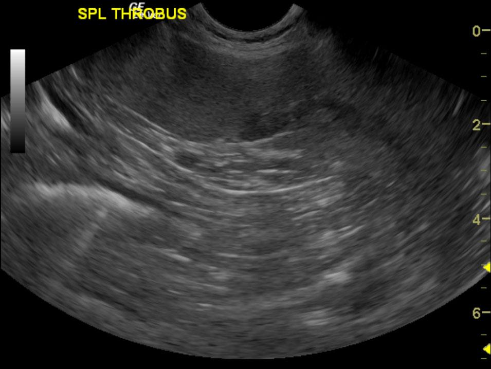 spleen_farley_vitalo_k9basset13yomnak_splenic_thrombus_2