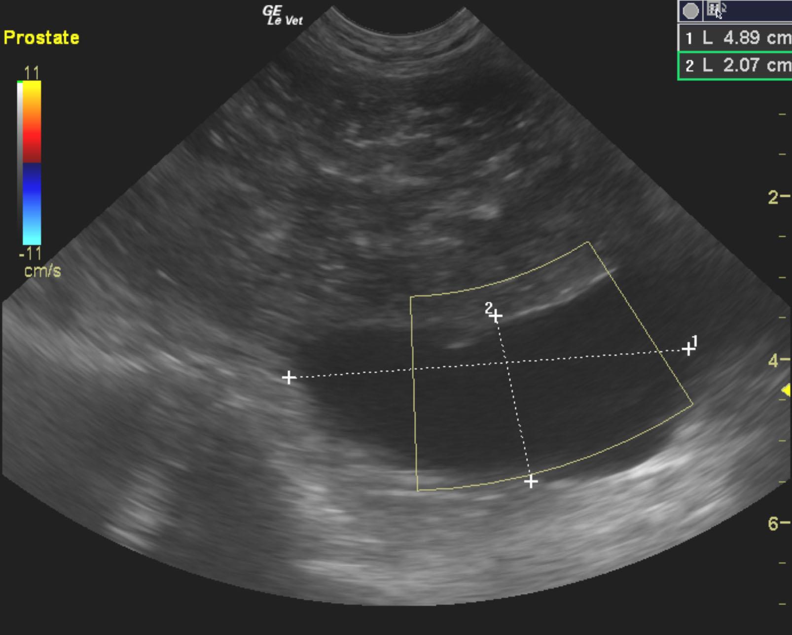 prostatic_carcinoma_in_tact_10_yr_berner_misha_mccarthy_cyst