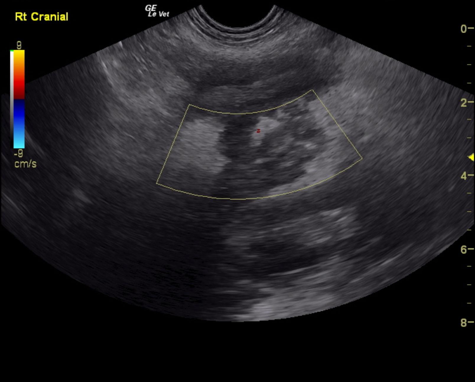 sixx_molly_pancreatitis_post_hep_obstruction_color