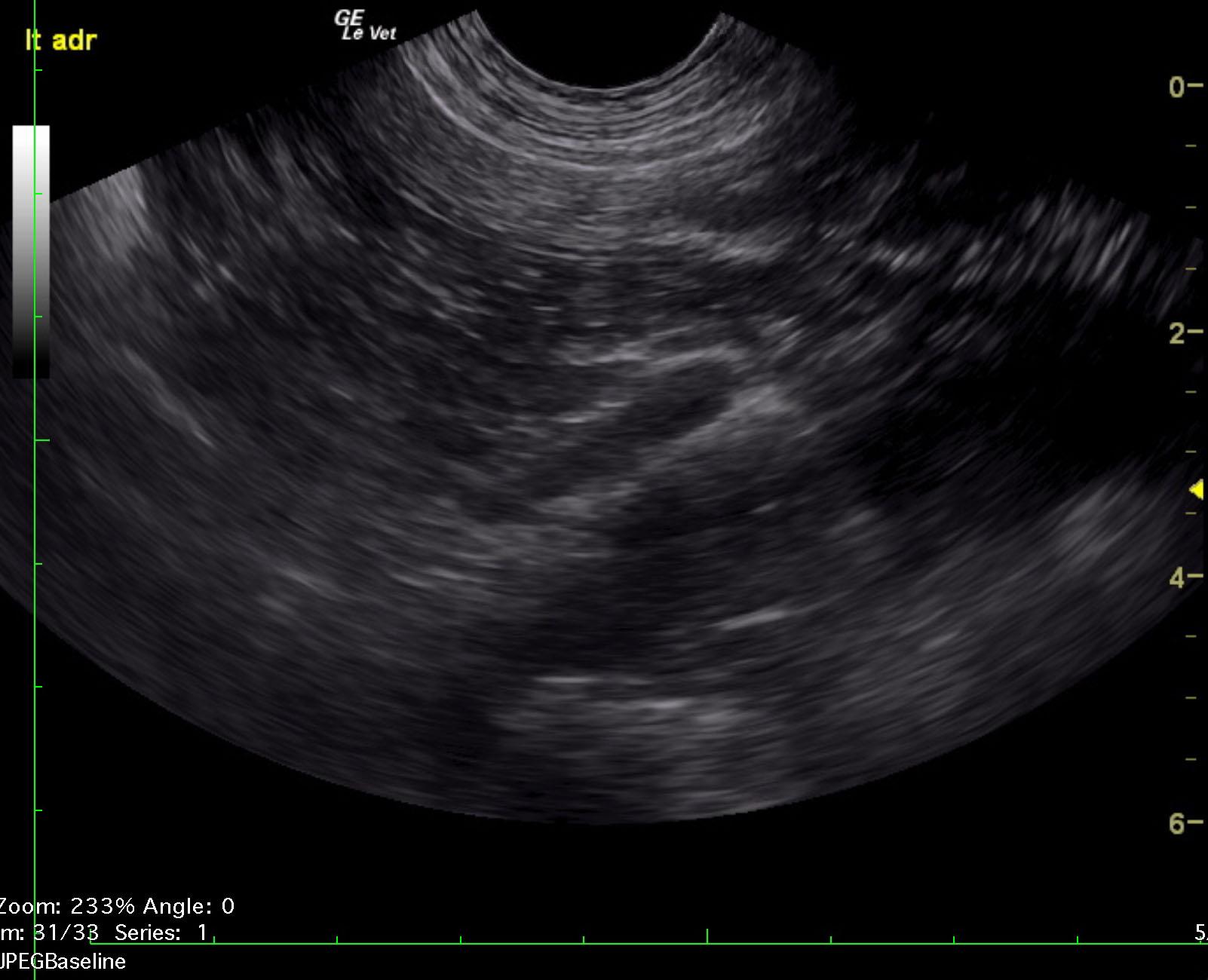 jolly_zoe_right_adrenal_mass_phrenic_invasion_left_adrenal_normal