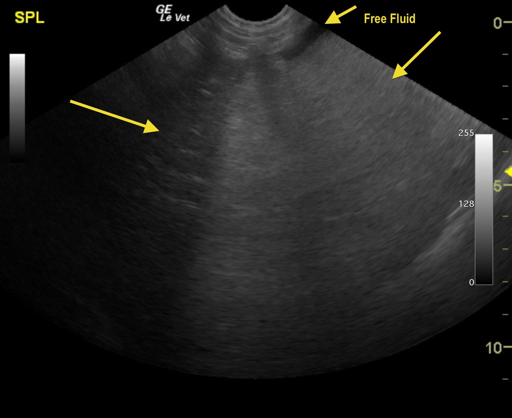 fitzsimons_blaize_ruptured_gbm_rj_spleen_liver_free_fluid