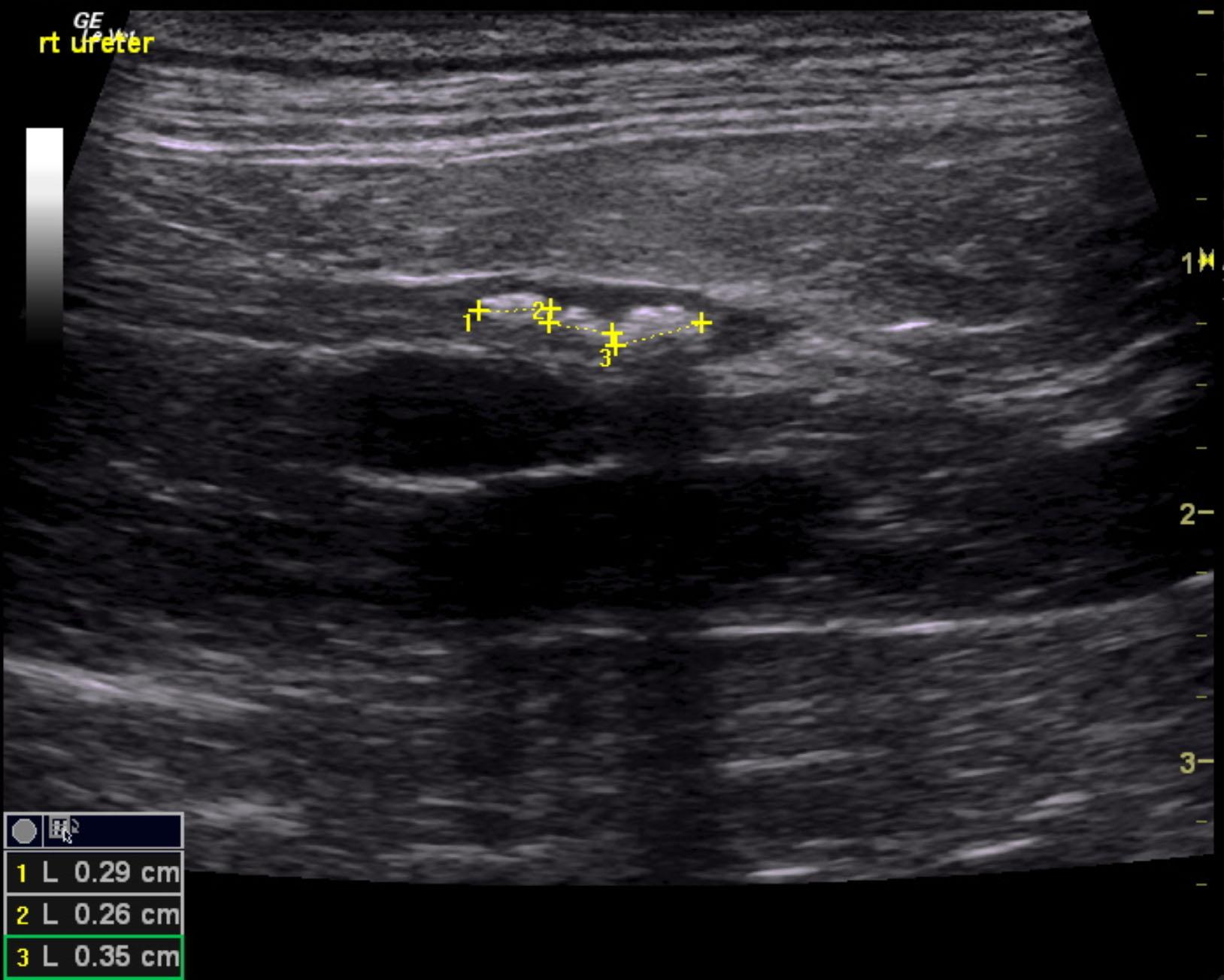 rieley_nemex_persistent_ureteral_stones_1_month_med_tx_2
