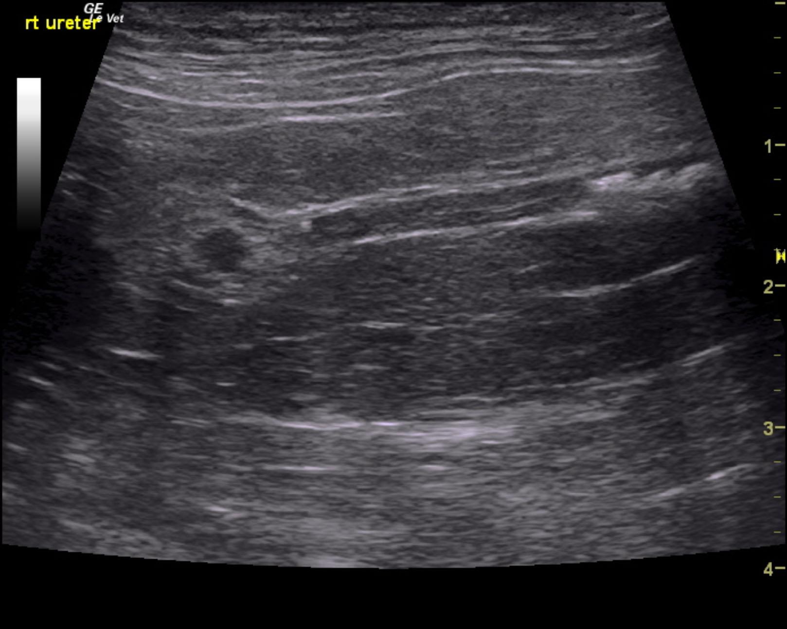 rieley_nemex_persistent_ureteral_stones_1_month_med_tx_3