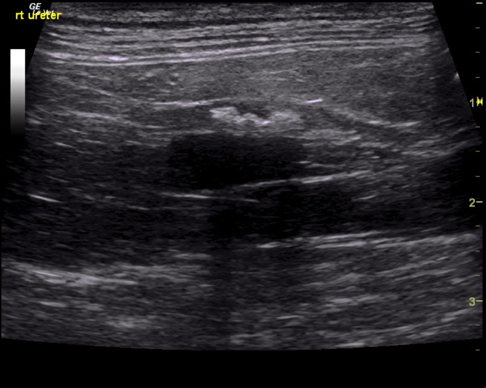 rieley_nemex_persistent_ureteral_stones_1_month_med_tx