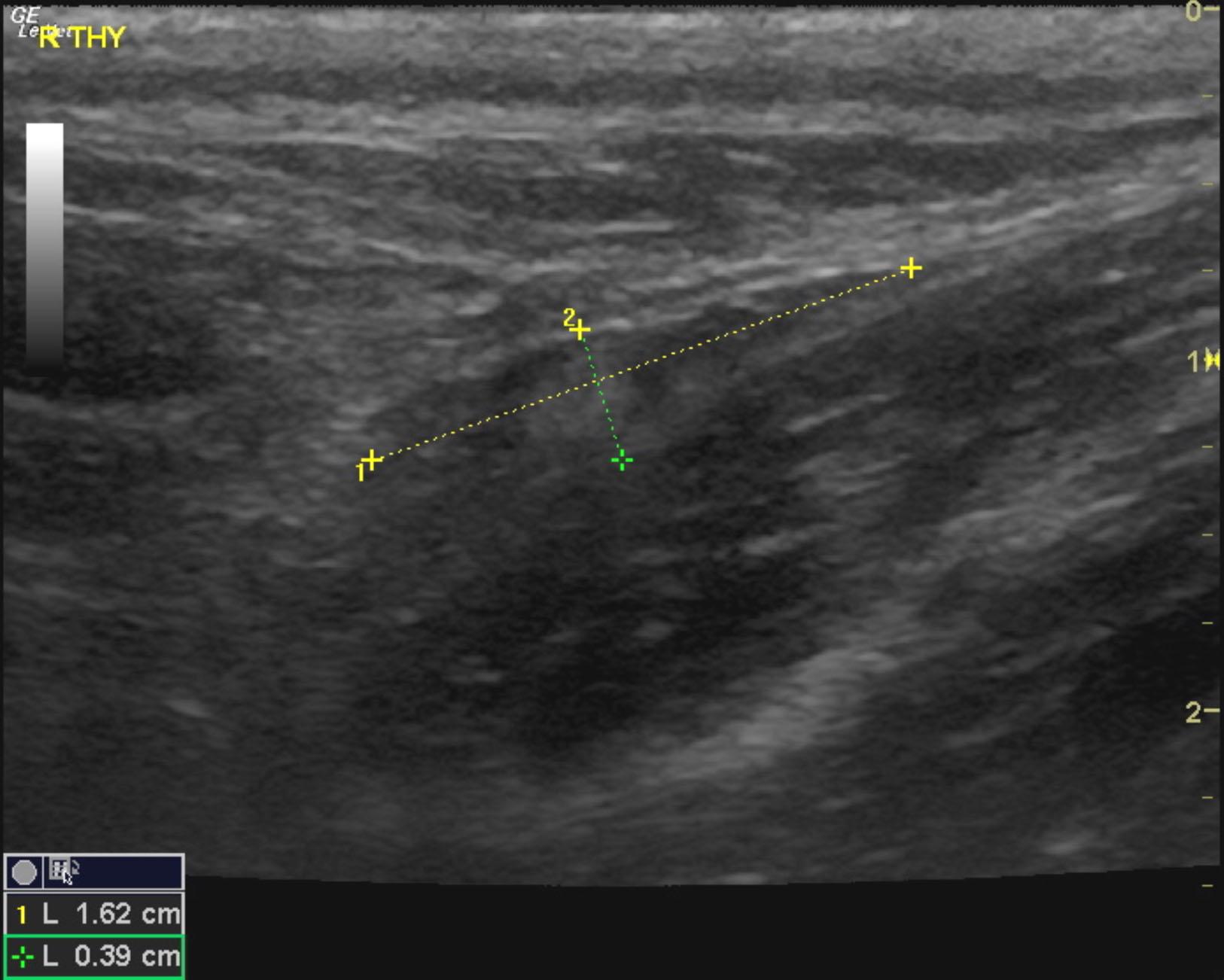 coco_martinez_parathyroid_adenoma_rt_thy_normal_fat_deposit