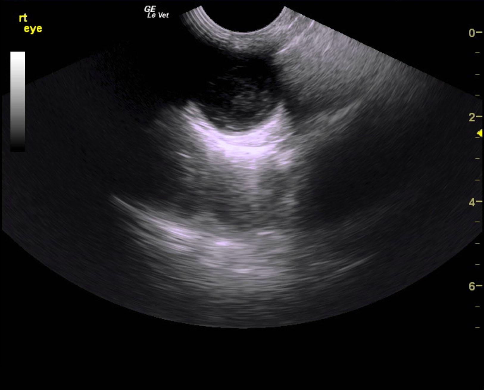 grady_krebs_uveitis_retinal_detachment_gluacoma_on_left