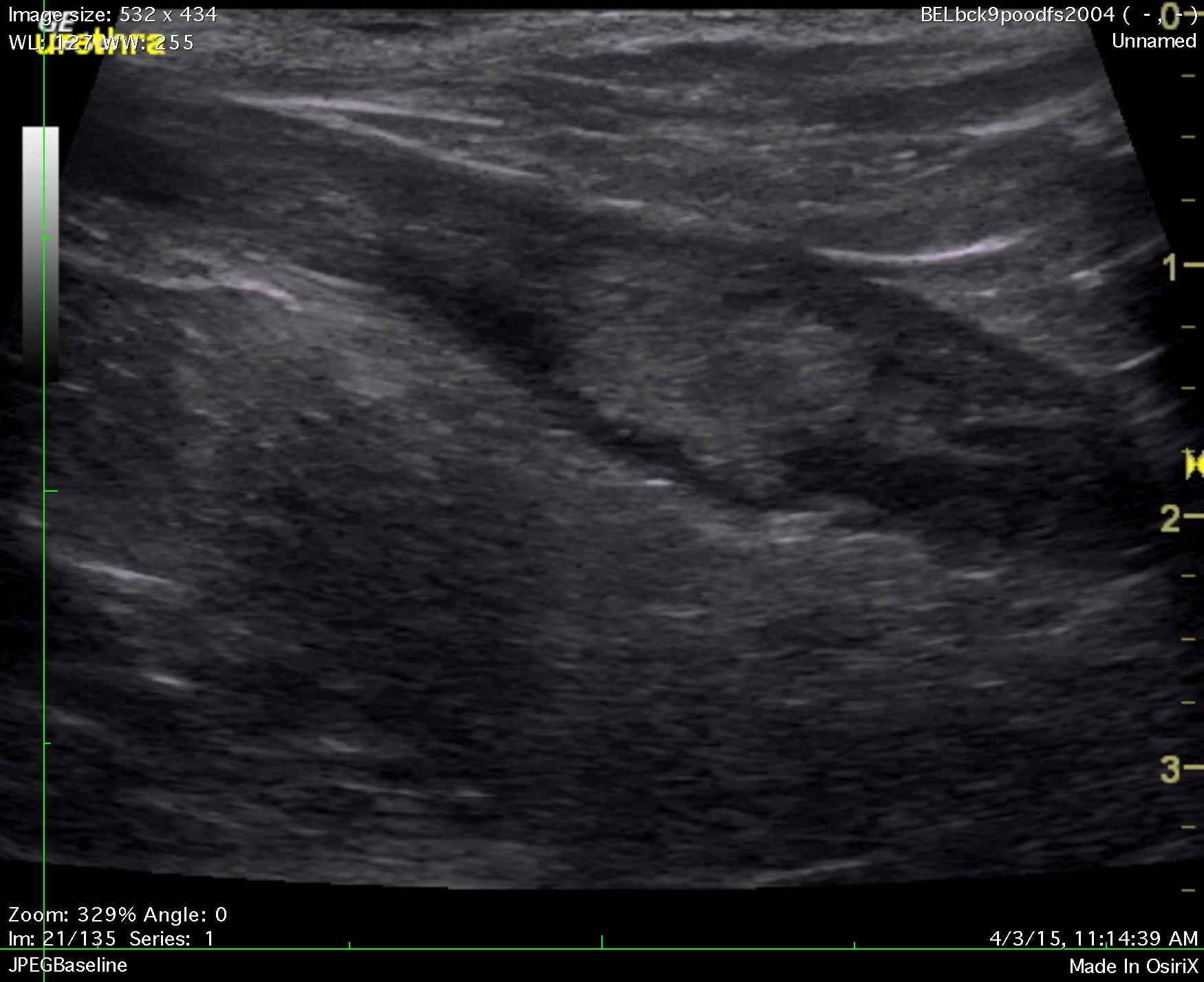 cormeny_butter_urethral_tcc_and_uti