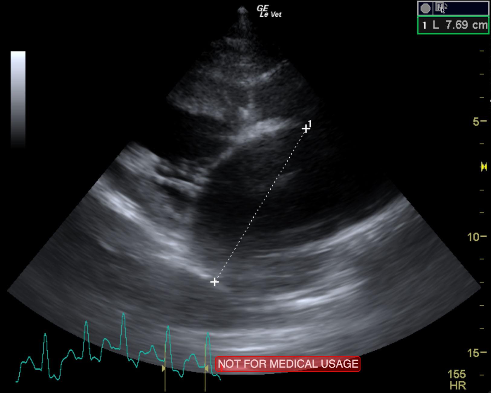 niu_niu_cao_end_stage_sas_myocardial_failure_left_chf