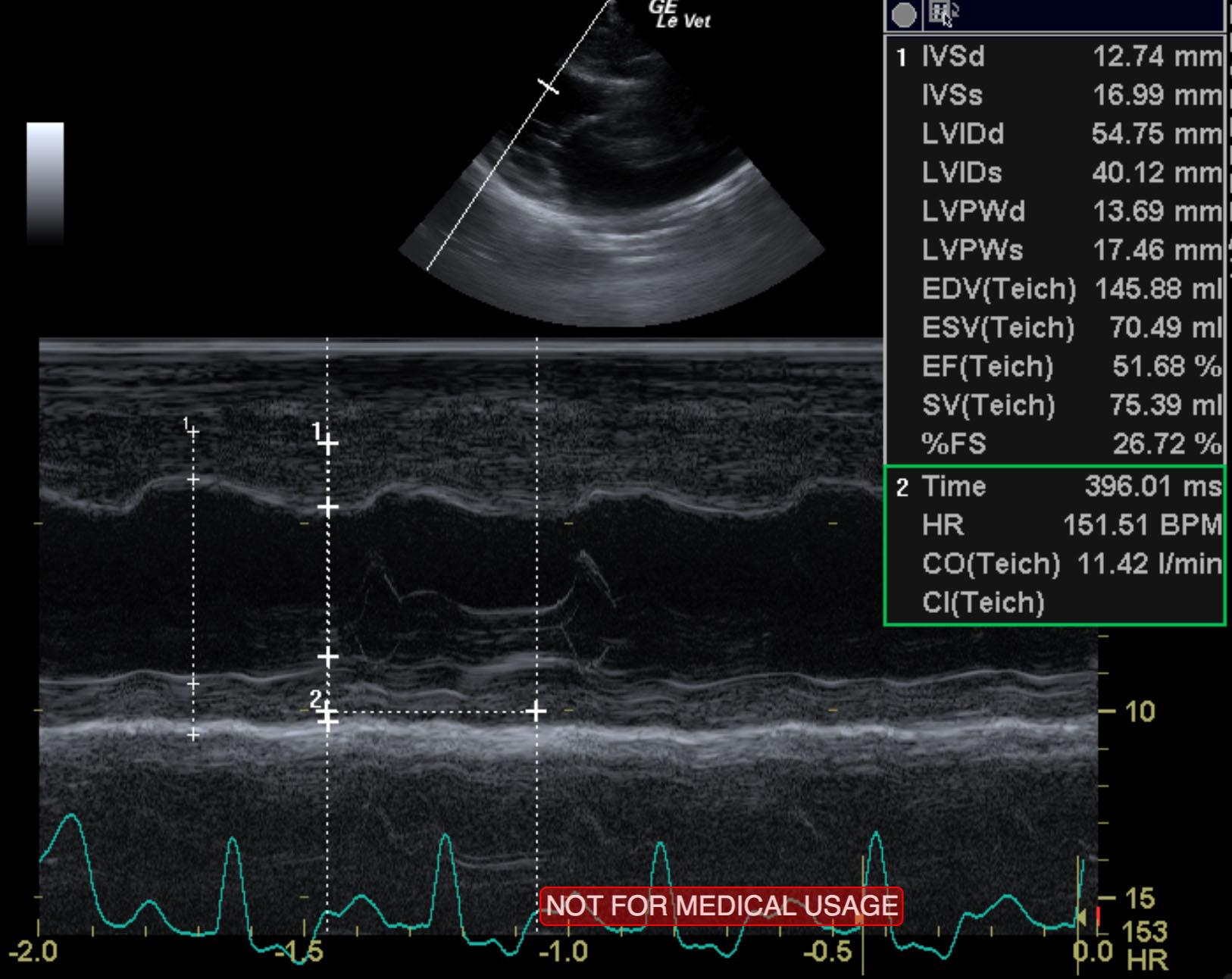niu_niu_cao_end_stage_sas_myocardial_failure_left_chf_lv_mmode