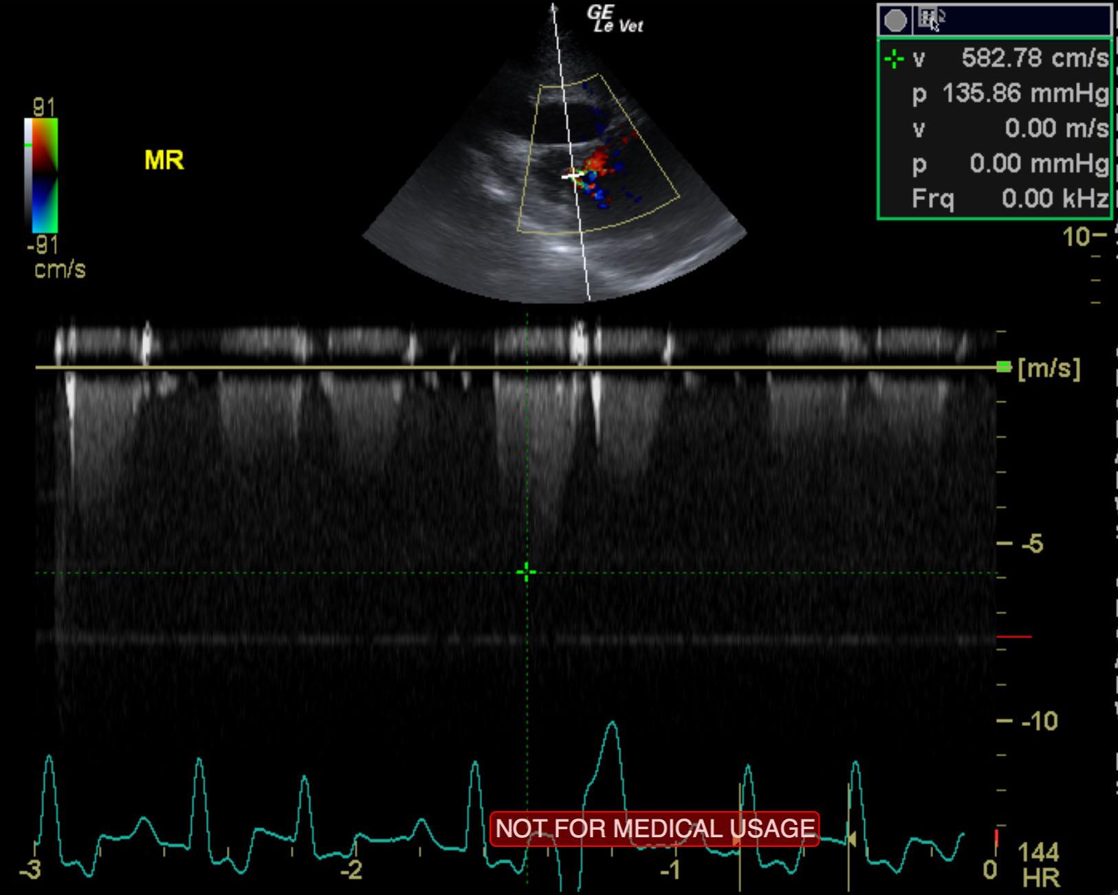 niu_niu_cao_end_stage_sas_myocardial_failure_left_chf_mr