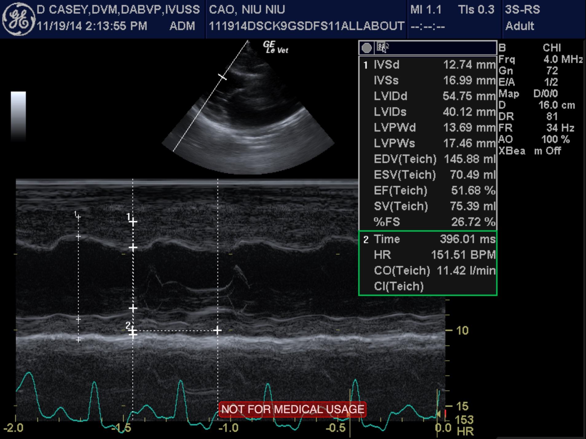niu_niu_cao_end_stage_sas_myocardial_failure_left_chf_lv_mmode