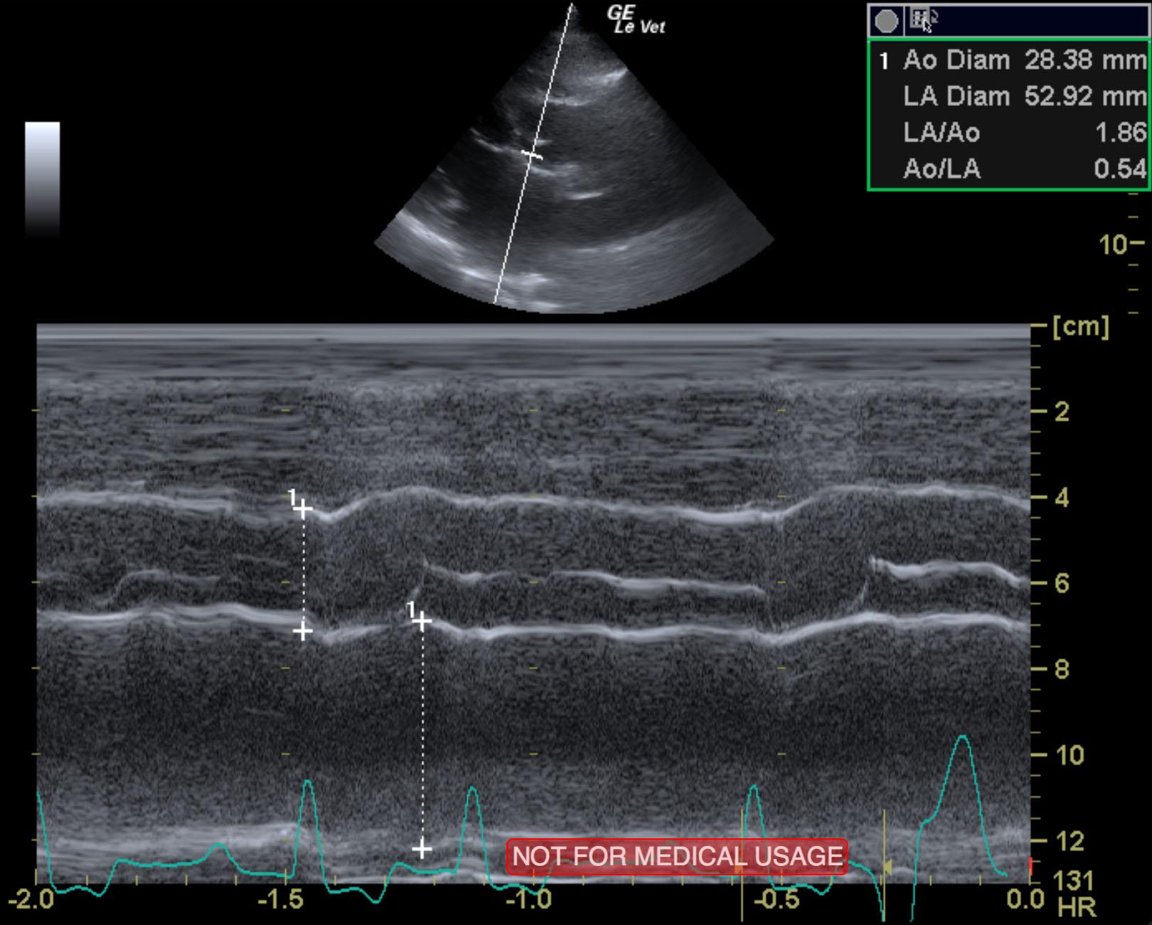 niu_niu_cao_end_stage_sas_myocardial_failure_left_chf_la_ao_boon