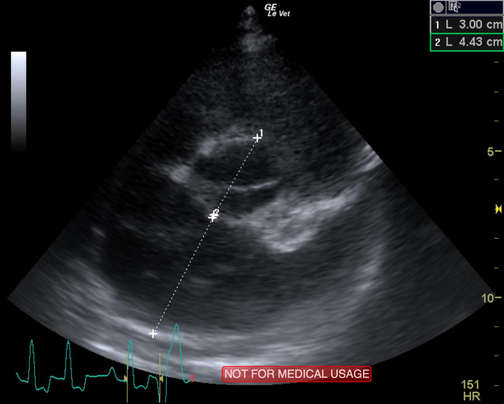 niu_niu_cao_end_stage_sas_myocardial_failure_left_chf_la_ao_heart_base