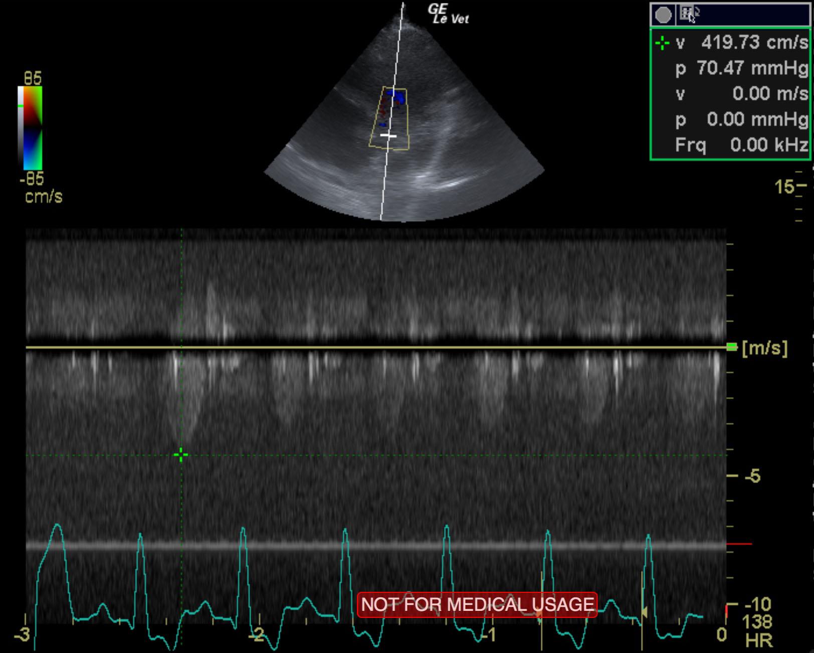 niu_niu_cao_end_stage_sas_myocardial_failure_left_chf_ao_vel