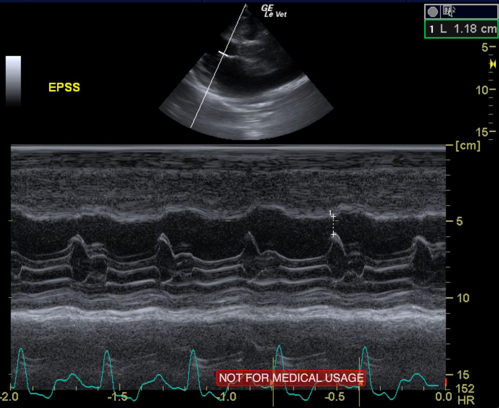 niu_niu_cao_end_stage_sas_myocardial_failure_left_chf_epss